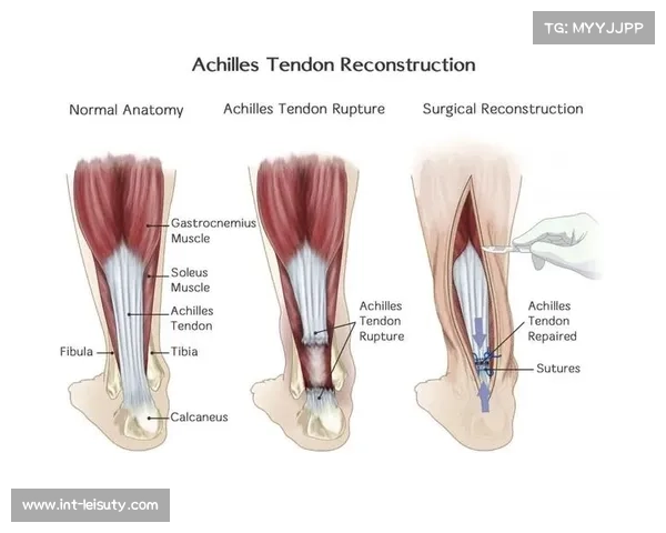 莱比锡亨里希斯跟腱伤势未愈，预计明年一月复出